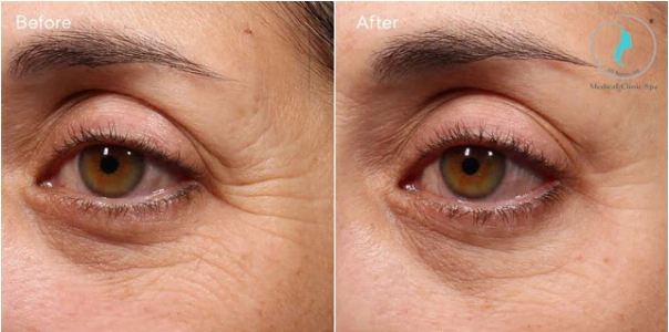 Kết quả sau khi dùng gel giảm nhăn, nâng cơ vùng mắt Ormedic Balancing Eye Lift Gel
